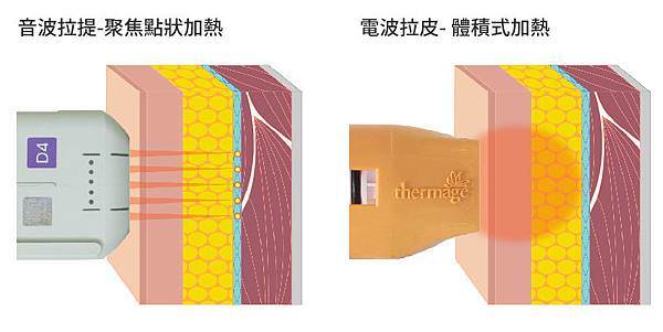 電音波拉提的加熱原理不同-樂芙美形診所.jpg