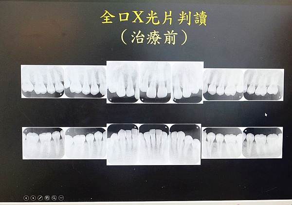 林口牙醫推薦-牙周植牙專科-康澤牙醫-牙齦快爛掉前，終於確定了牙周病治療診所，牙周植牙專科-江明學醫師推薦555.jpg