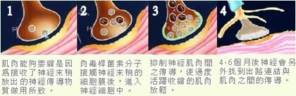 肉毒除皺的作用原理圖.jpg