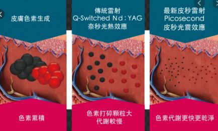 皮秒雷射技術說明-杰膚美.JPG