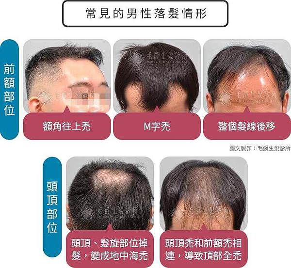 男性雄性禿嚴重程度區分-毛爵.jpg