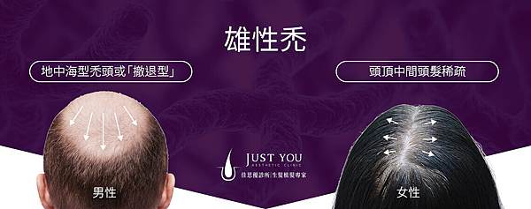 男女雄性禿的掉髮差別-佳思優.jpg