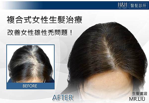 女性雄性禿治療-H%26;H.jpg