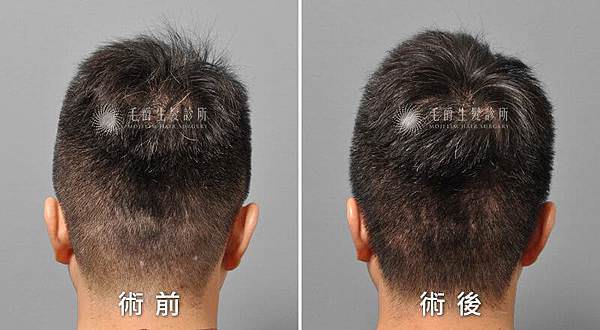 免剃植髮手術分享1.jpg