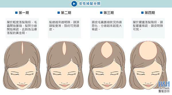 女性雄性禿掉髮階段-陳駿逸診所.jpg