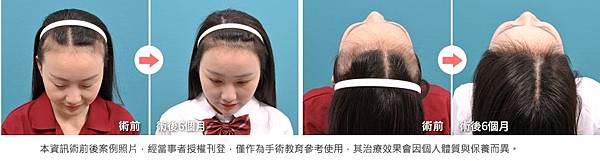 植髮費用和效果的關係探討大整理2020.jpg