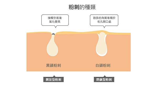 粉刺的種類怎麼分，白頭粉刺，黑頭粉刺.jpg