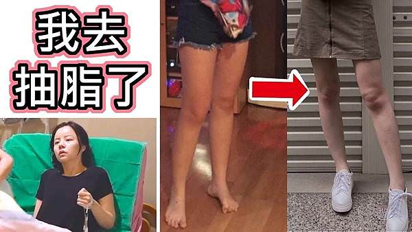 我去抽脂了-超直白.jpg