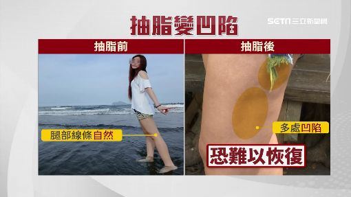 抽脂凹凸不平報導-三立新聞.jpg