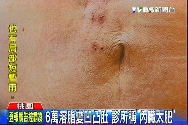 抽脂失敗-後遺症-費用價格_黃政達醫師.jpg