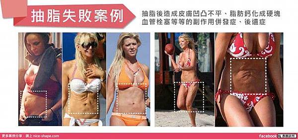 媒體報導-抽脂失敗-抽脂後遺症1.jpg