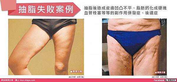 媒體報導-抽脂失敗-抽脂後遺症.jpg