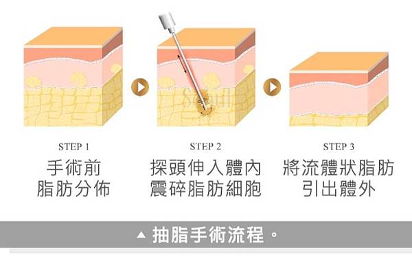 抽脂手術過程_首爾診所.jpg