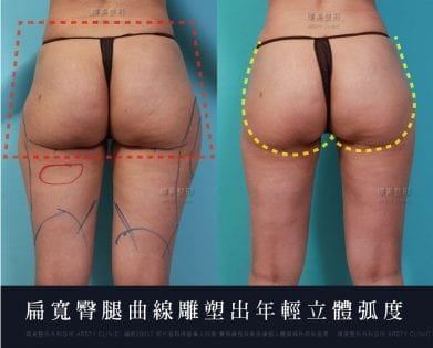 臀部抽脂_璞美.jpg