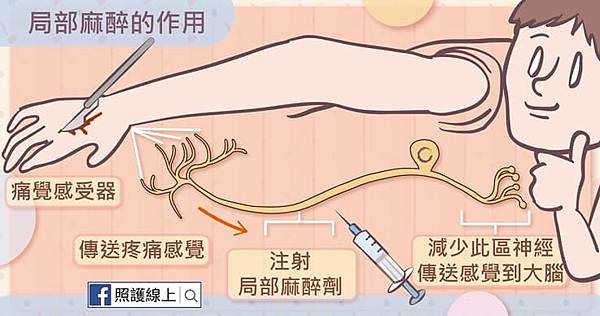 什麼是局部麻醉-照護線上.jpg