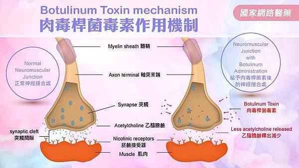 不是所有人都適合肉毒除皺小臉_元氣網.jpeg
