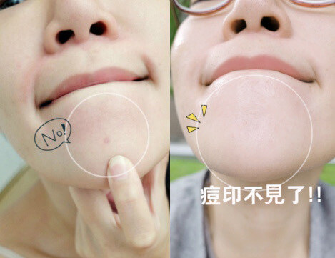 婕洛妮絲藜麥抗痘精華｜痘痘痕跡不要來.jpg