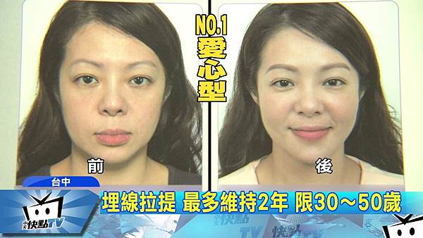 線雕拉提後遺症-中天新聞.jpg