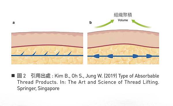 線雕拉效果-關鍵評論網.jpg