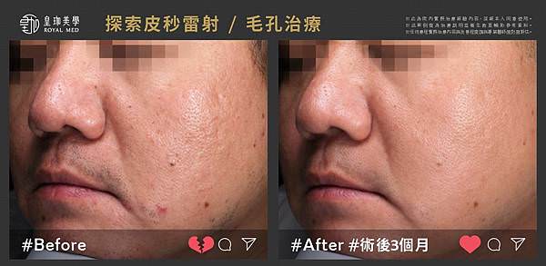 皮秒雷射改善毛孔粗大.jpg
