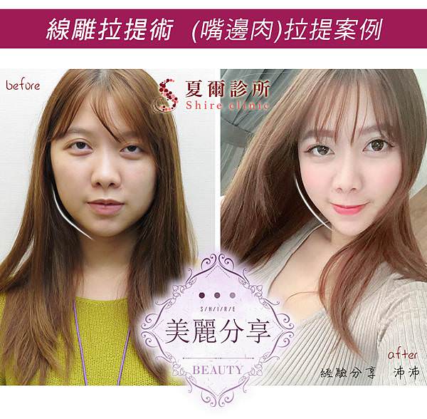 埋線拉提改善嘴邊肉效果_夏爾診所.jpg