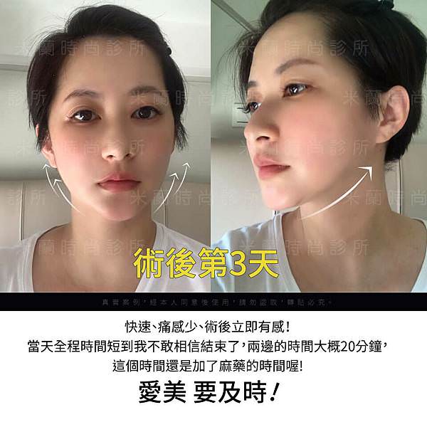 埋線拉提術後立即有感_米蘭時尚診所.jpg