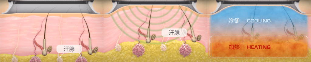 miraDry-清新微波-原理.png