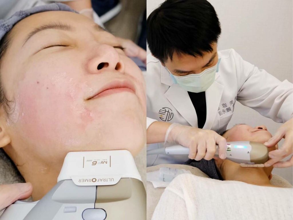 皇珈美學,劉永麟醫師,海芙音波拉提術後