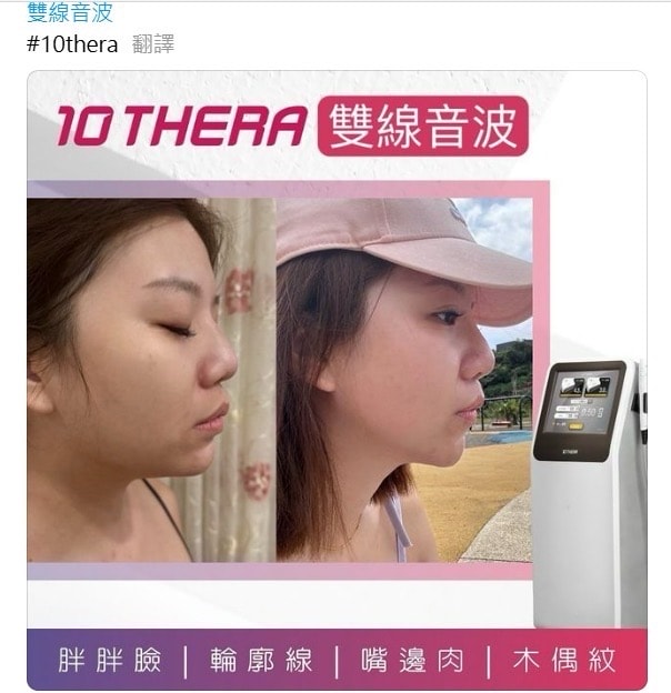 悅緹妍ptt實測7天擊退雙下巴有夠神!雙線音波價格/效果全分享! - 第3張圖 雙線音波效果