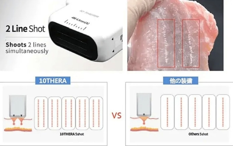 悅緹妍ptt實測7天擊退雙下巴有夠神!雙線音波價格/效果全分享! - 第5張圖 10Thera雙線音波