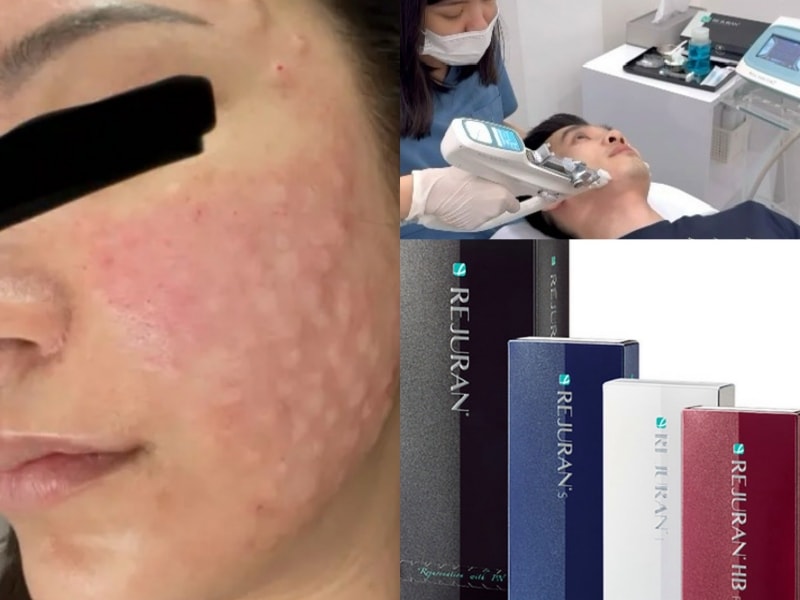 麗珠蘭副作用？dcard爆發評價論戰？麗珠蘭注射台灣價格2024更新！