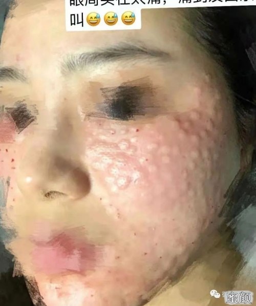 水光針多久打一次