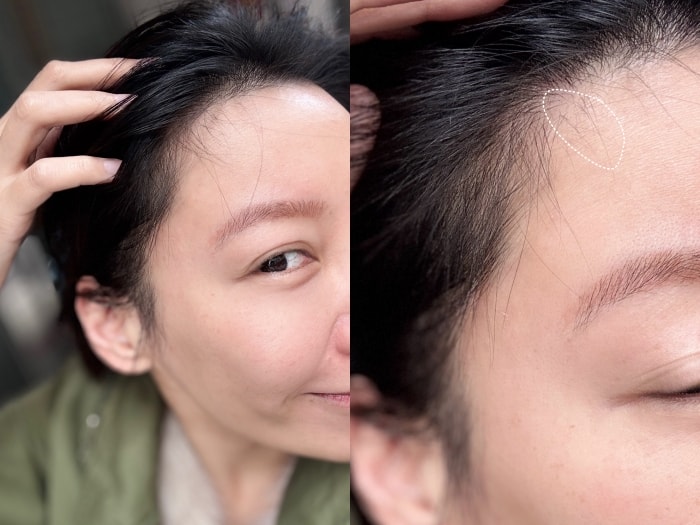 髮利明有效嗎?髮利明AHK藍銅髮根噴劑1天1次,連續使用6週實測,髮際線密度真的回來了! - 第31張圖 髮利明有效嗎,髮利明AHK藍銅髮根滋養噴劑