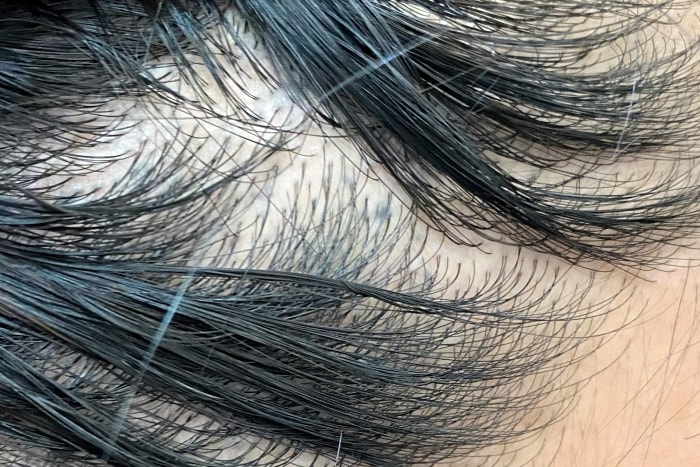 髮利明有效嗎?髮利明AHK藍銅髮根噴劑1天1次,連續使用6週實測,髮際線密度真的回來了! - 第2張圖 髮利明有效嗎,髮利明AHK藍銅髮根滋養噴劑