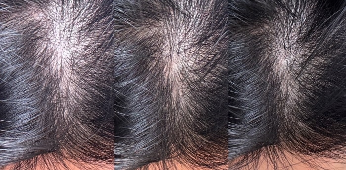 髮利明有效嗎?髮利明AHK藍銅髮根噴劑1天1次,連續使用6週實測,髮際線密度真的回來了! - 第47張圖 髮利明有效嗎,髮利明AHK藍銅髮根滋養噴劑