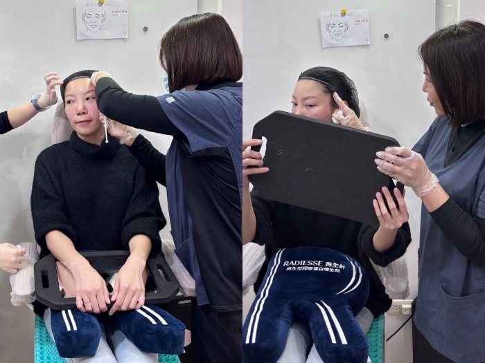 維昕診所dcard評價推嗎?再生針輪廓固定術後7天真實變化全紀錄 - 第16張圖 維昕診所,劉思慧醫師,再生針