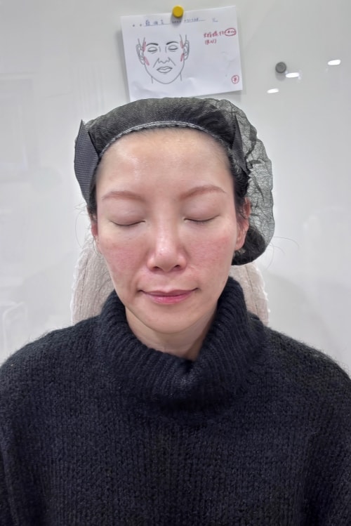 維昕診所dcard評價推嗎?再生針輪廓固定術後7天真實變化全紀錄 - 第18張圖 維昕診所,劉思慧醫師,再生針