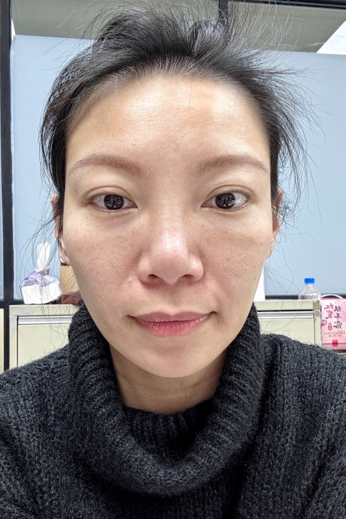 維昕診所dcard評價推嗎?再生針輪廓固定術後7天真實變化全紀錄 - 第8張圖 維昕診所,劉思慧醫師,再生針