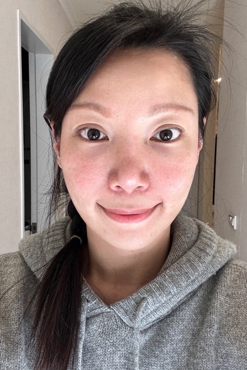維昕診所dcard評價推嗎?再生針輪廓固定術後7天真實變化全紀錄 - 第10張圖 維昕診所,劉思慧醫師,再生針