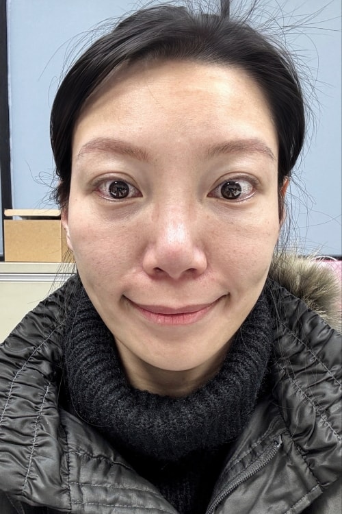 維昕診所dcard評價推嗎?再生針輪廓固定術後7天真實變化全紀錄 - 第9張圖 維昕診所,劉思慧醫師,再生針