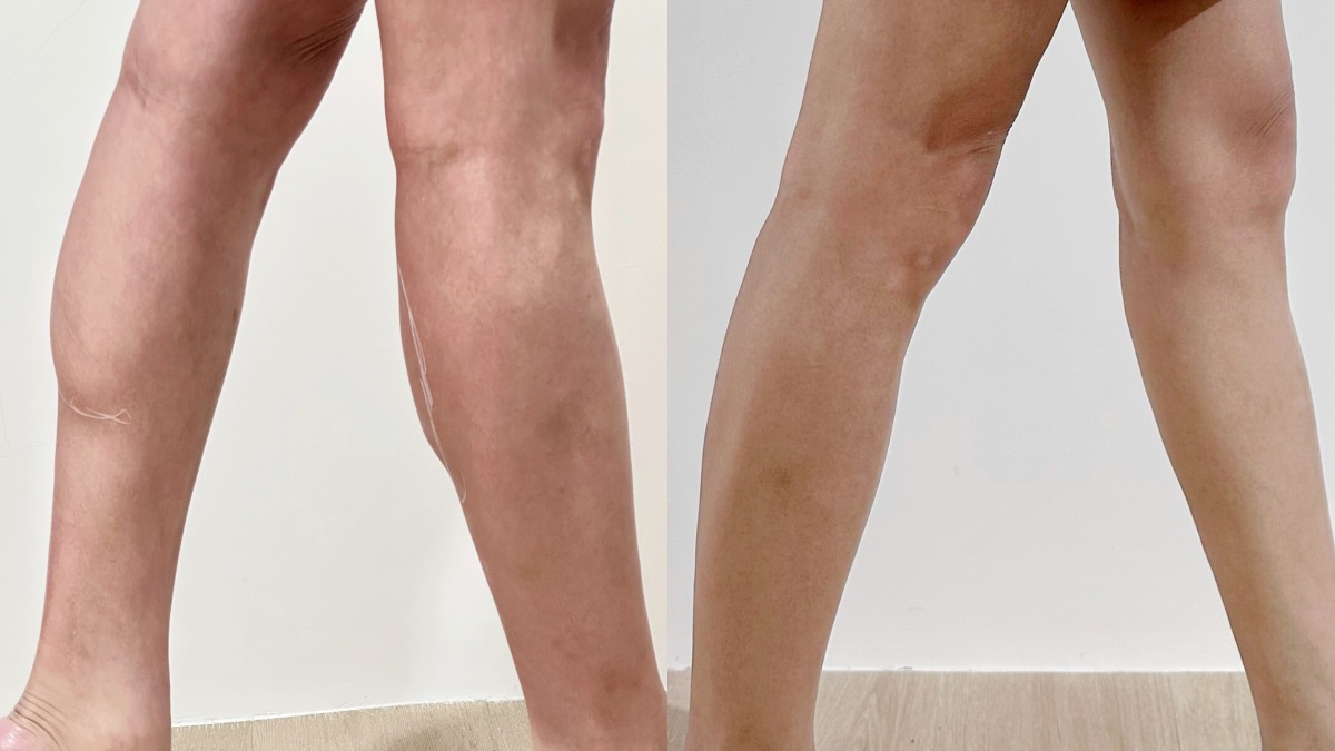 奇蹟肉毒小腿實測|完美主義美學診所評價、費用與術後記錄:2~3週消滅蘿蔔腿! - 第22張圖 肉毒小腿,完美主義美學診所,蘇摸摸S 97050654
