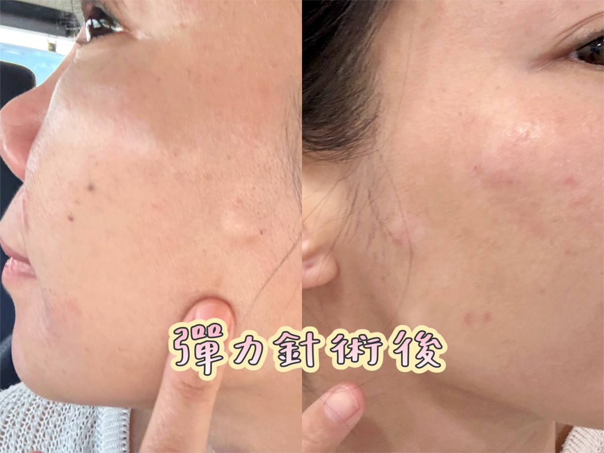 彈力針效果,彈力針術後當天,蘇摸摸,佳思優