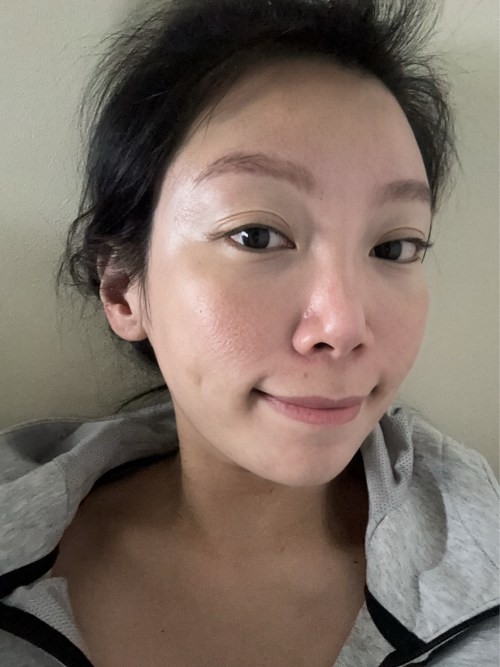 彈力針效果,彈力針逆時針差別,彈力針術後生活照,蘇摸摸