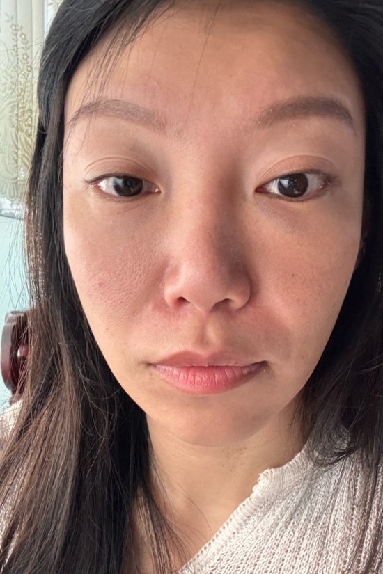 新願美學診所評價,新願美學診所dcard,新願美學,蘇摸摸術前2