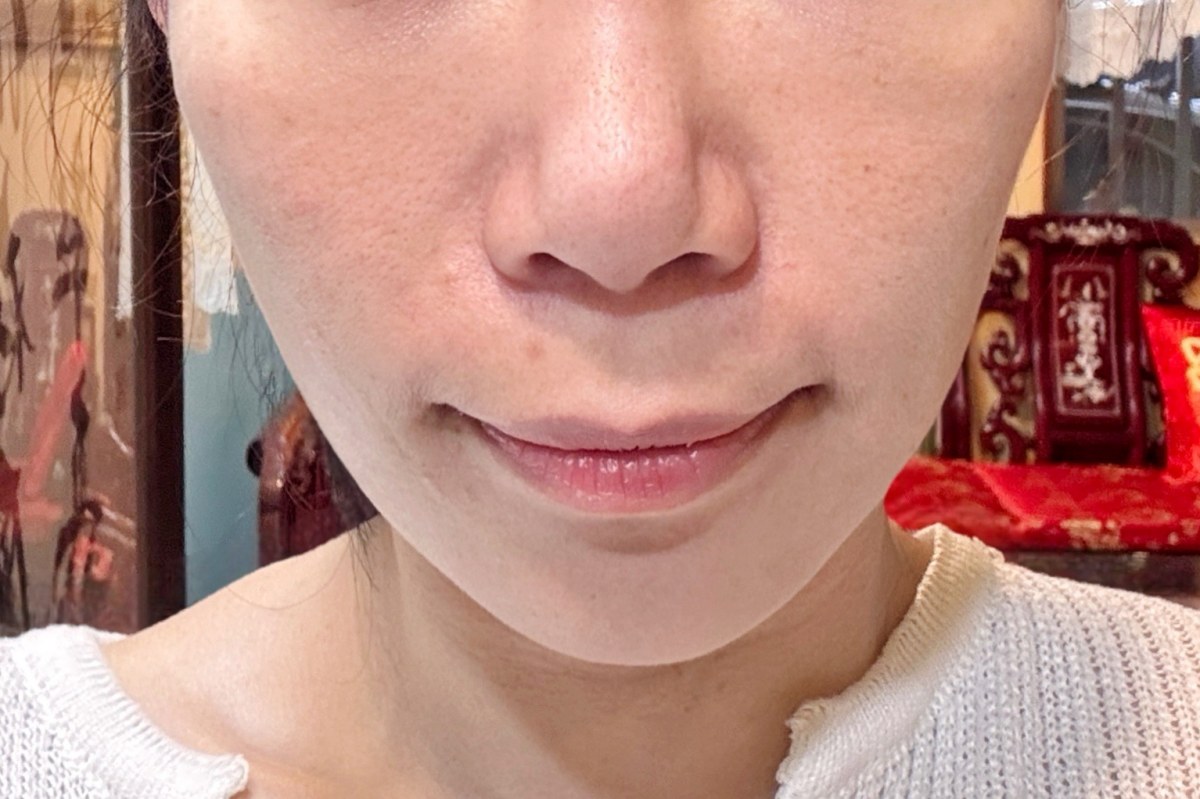 新願美學診所評價,新願美學診所dcard,新願美學診所術後一個月,蘇摸摸