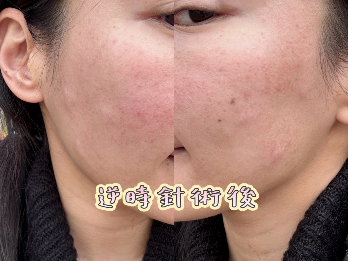 逆時針效果,逆時針術後當天,蘇摸摸,佳思優